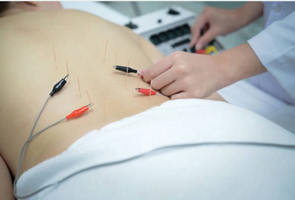 Eletroacupuntura